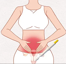 HPV女性健康筛查