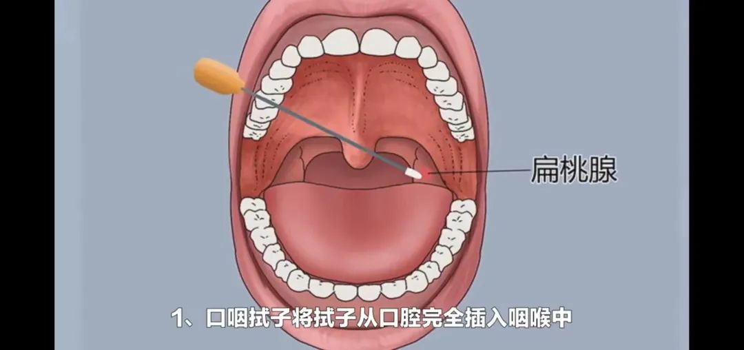 口咽拭子采集口腔样本图解